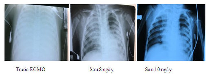 Hình ảnh Xquang phổi trên bệnh nhân dùng ECMO.