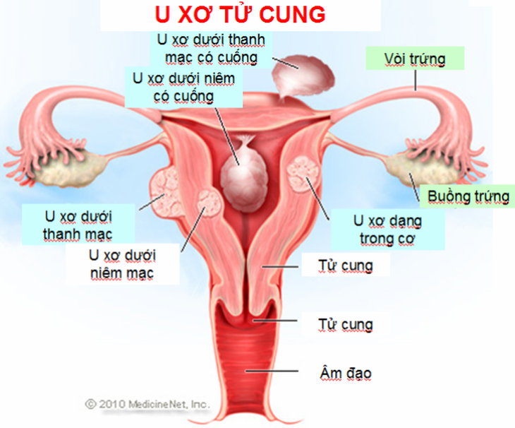 U xơ tử cung