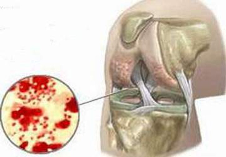 Hình ảnh mủ trong khớp gối bị viêm.
