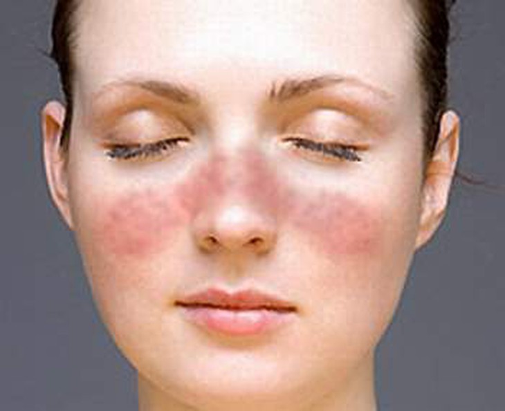 Xơ cứng bì do hội chứng Raynaud