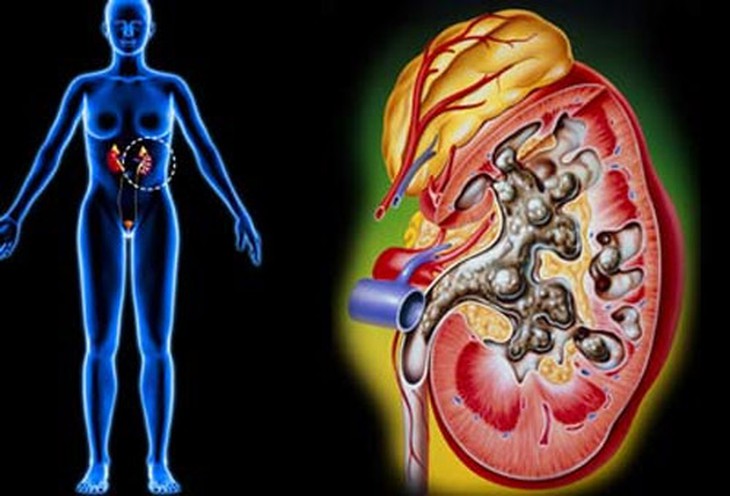 Ăn quá nhiều mận có thể gây sỏi thận (Ảnh minh họa)