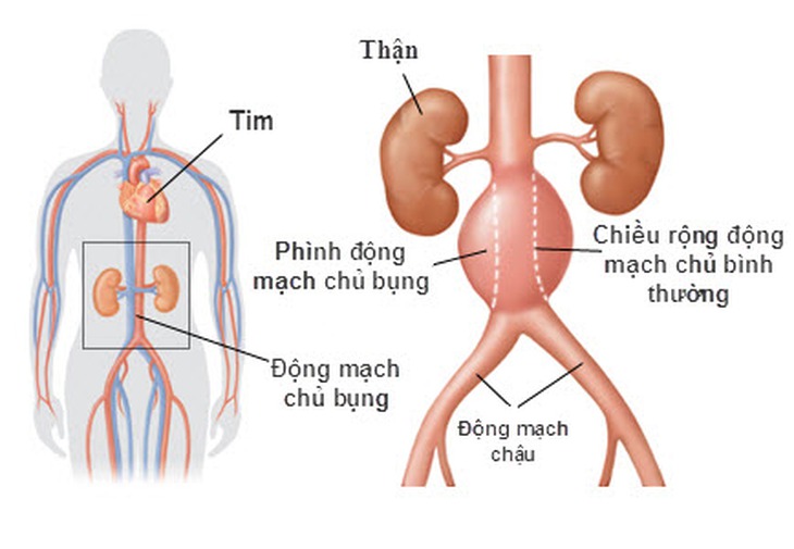 Phình động mạch chủ bụng. Ảnh minh họa: internet
