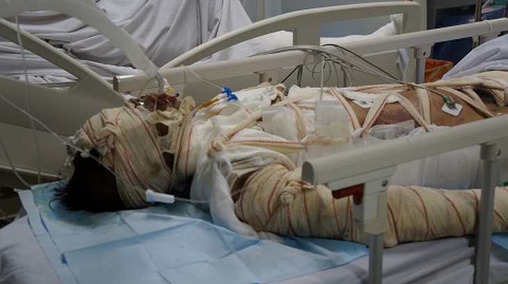Lao vào biển lửa cứu con, mẹ bị cháy như đuốc
