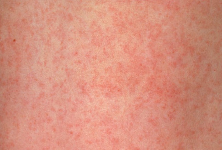 Rubella