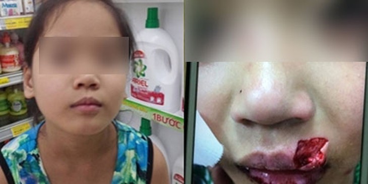 bị chó cắn, nuôi chó, tiêm phòng dại