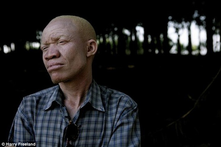 Tanzania: Người bạch tạng bị cắt chi, buôn bán như động vật