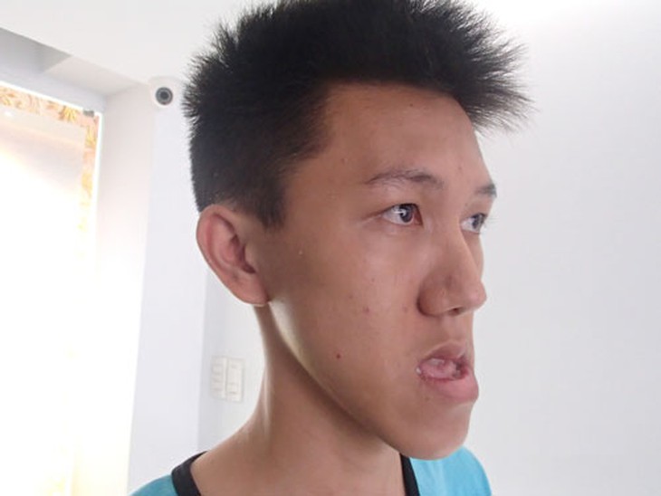Gương mặt Anh Khoa khi chưa được phẫu thuật