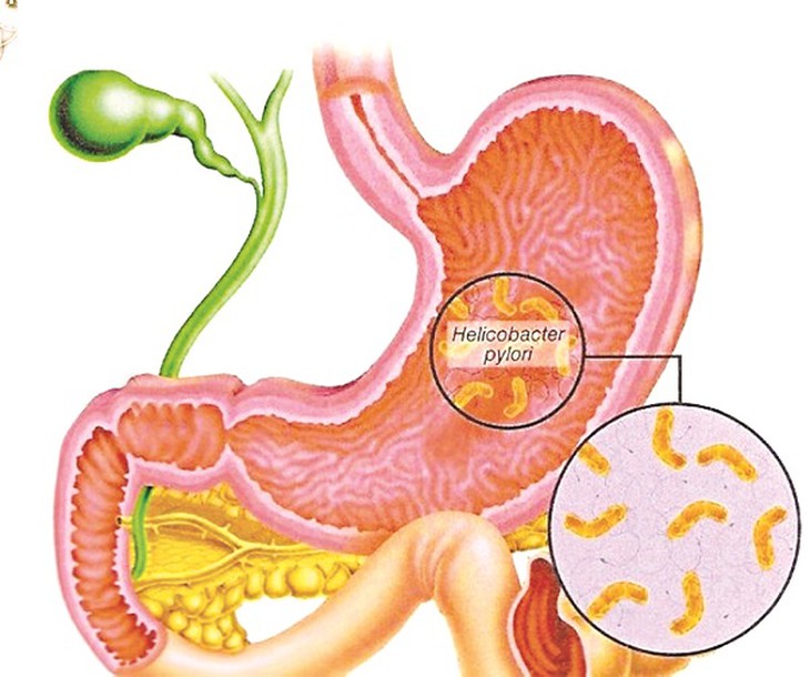 90% số bệnh nhân loét tá tràng có sự hiện diện Helicobacter pylori