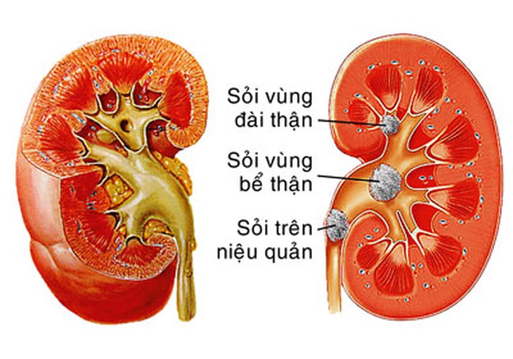 thừa canxi gây sỏi thận