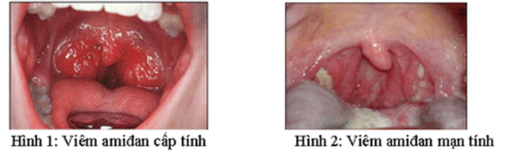 Viêm họng mạn tính có thể dẫn đến viêm amiđan.