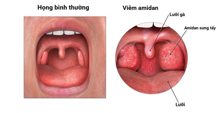 Viêm họng cấp và những điều cần biết - Ảnh 3.