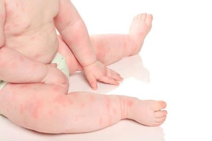 Bác sĩ có thể khuyên bạn thay thế loại sữa công thức nếu em bé của bạn có dấu hiệu dị ứng sữa bò.