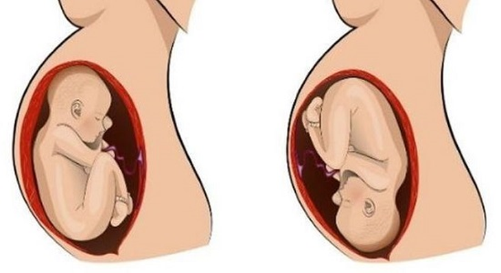 Những rắc rối nếu thai nhi không quay đầu - Ảnh 2. Những rắc rối nếu thai nhi không quay đầu - Ảnh 2.