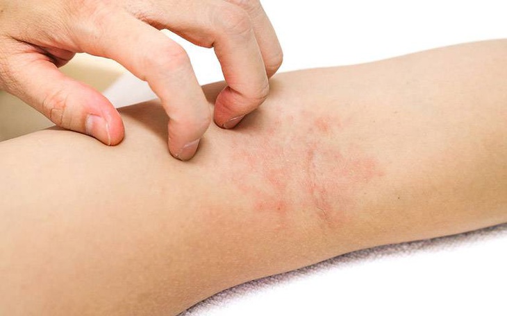 Giải pháp an toàn cho bệnh viêm da cơ địa mùa COVID