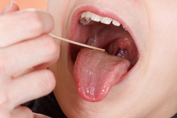 Viêm họng cấp và những điều cần biết - Ảnh 4.