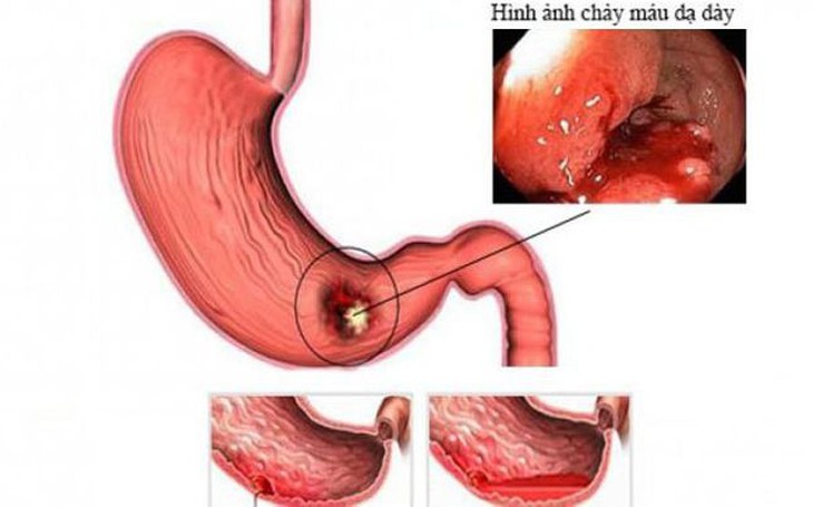 Cần phát hiện sớm xuất huyết tiêu hóa ở trẻ em - Ảnh 2. Cần phát hiện sớm xuất huyết tiêu hóa ở trẻ em - Ảnh 2.