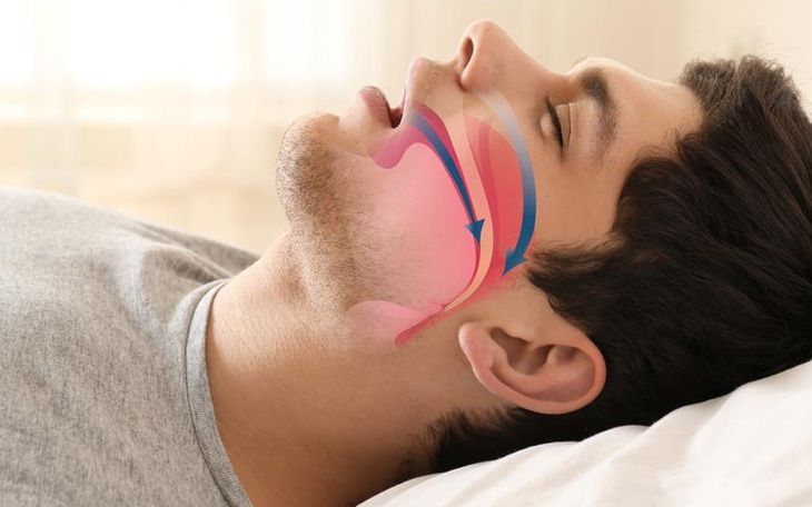 Nhóm người dễ mắc hội chứng ngừng thở khi ngủ và những biến chứng nguy hiểm