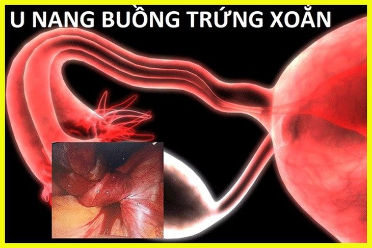 U nang buồng trứng có nguy hiểm không? Làm thế nào để phòng bệnh? - Ảnh 1.