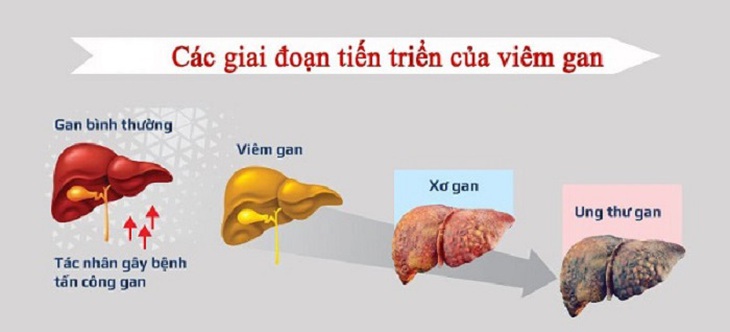 Khám định kỳ vẫn không phát hiện sớm ung thư gan do đâu? - Ảnh 1. Khám định kỳ vẫn không phát hiện sớm ung thư gan do đâu? - Ảnh 1.