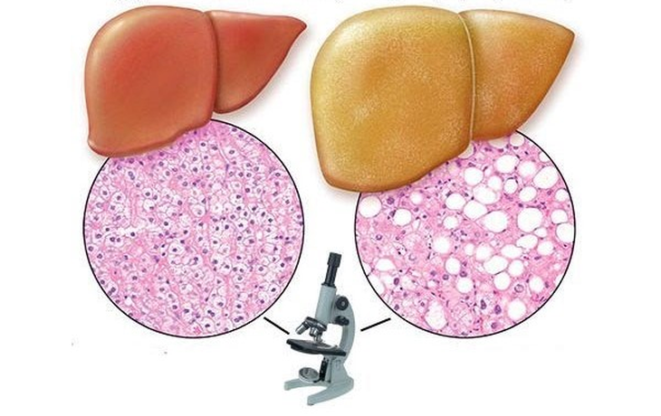 Gan nhiễm mỡ có nên uống thuốc bổ gan ? - Ảnh 1.