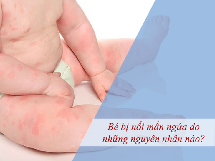 Giải pháp nào cho bé thường thường xuyên bị mẩn ngứa? - Ảnh 1.