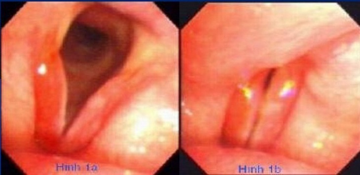 Hình ảnh viêm thanh quản cấp qua nội soi. Hình ảnh viêm thanh quản cấp qua nội soi.