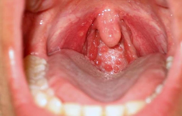 7 phương pháp đốt viêm họng hạt, cắt amidan hiệu quả, ít đau - Ảnh 2.