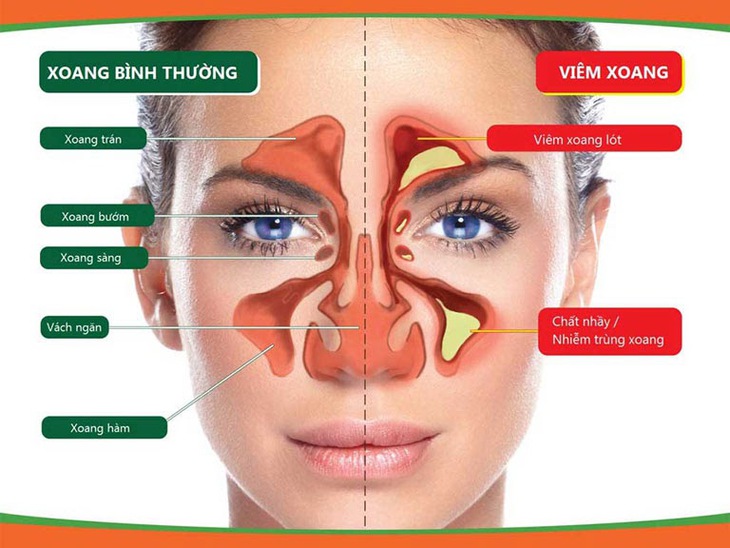 Chữa viêm xoang và những điều cần biết - Ảnh 1. Chữa viêm xoang và những điều cần biết - Ảnh 1.