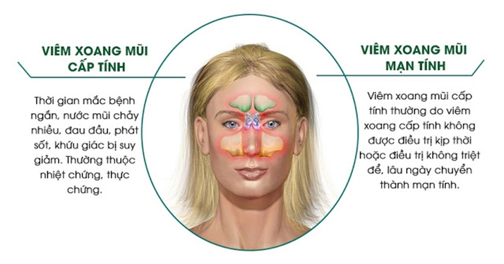 Viêm xoang: Dấu hiệu, cách phòng ngừa và điều trị tại nhà hiệu quả dành cho người lớn - Ảnh 1.