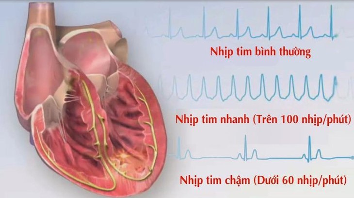 Triệu chứng nào mách bảo bạn đang bị rối loạn nhịp tim? - Ảnh 1.