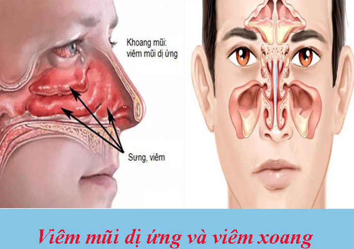 Viêm xoang và viêm mũi dị ứng: Những dấu hiệu cần phân biệt - Ảnh 1. Viêm xoang và viêm mũi dị ứng: Những dấu hiệu cần phân biệt - Ảnh 1.