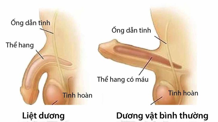Rối loạn cương dương ở người bệnh đái tháo đường - Ảnh 3. Rối loạn cương dương ở người bệnh đái tháo đường - Ảnh 3.