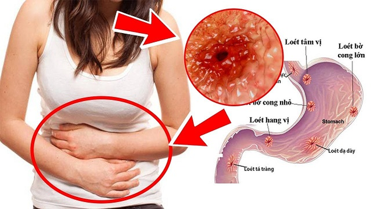 Đột phá mới cho người bệnh dạ dày - Ảnh 1.