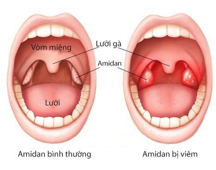 Đông y trị viêm amidan cấp - Ảnh 1.