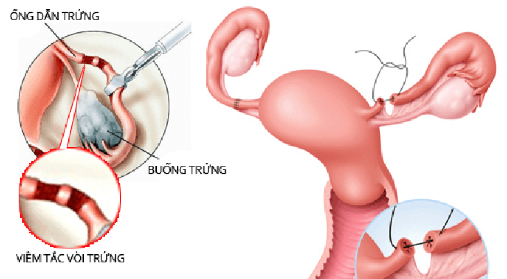 Dấu hiệu vô sinh ở nữ giới và nam giới - Ảnh 2.