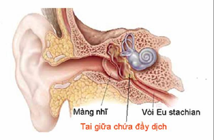 Viêm tai ứ dịch ở trẻ em - Ảnh 3.