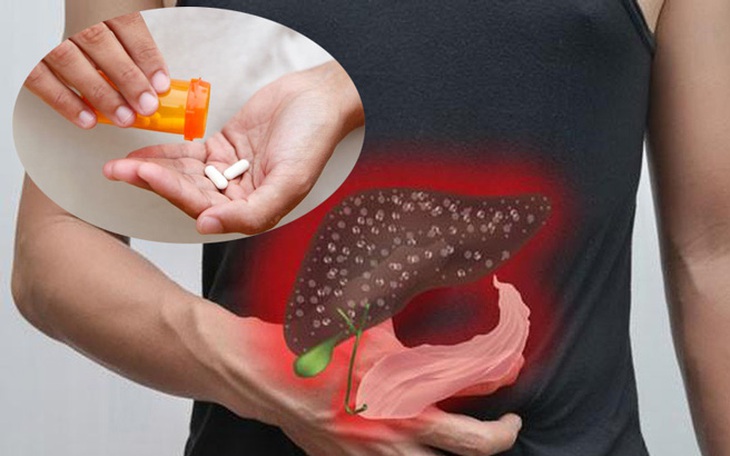 Sỏi túi mật: Dấu hiệu, nguyên nhân và điều trị