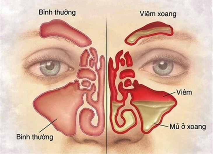 Viêm xoang cấp tính nung mủ ai dễ mắc và biểu hiện ra sao? - Ảnh 1. Viêm xoang cấp tính nung mủ ai dễ mắc và biểu hiện ra sao? - Ảnh 1.