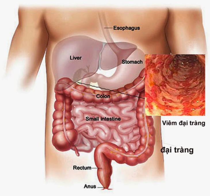 Đông y trị viêm đại tràng - Ảnh 1. Đông y trị viêm đại tràng - Ảnh 1.