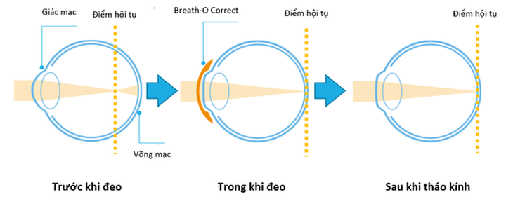  Điều chỉnh cận thị, hạn chế tăng độ không phẫu thuật qua giấc ngủ - Ảnh 1.