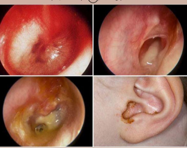 Viêm tai ứ dịch ở trẻ em - Ảnh 5.