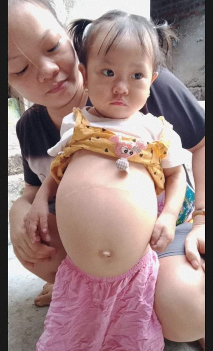 Sự sống mong manh của bé gái bụng to như trống vì bệnh hiểm nghèo - Ảnh 3. Sự sống mong manh của bé gái bụng to như trống vì bệnh hiểm nghèo - Ảnh 3.