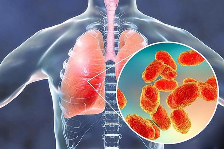 Bệnh viêm tiểu phế quản ở trẻ: Nhận biết, điều trị và những lưu ý - Ảnh 5.