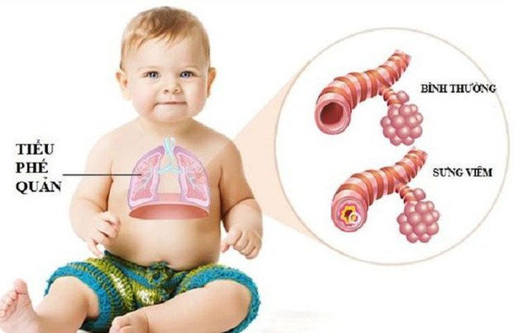 Bệnh viêm tiểu phế quản ở trẻ: Nhận biết, điều trị và những lưu ý - Ảnh 3.
