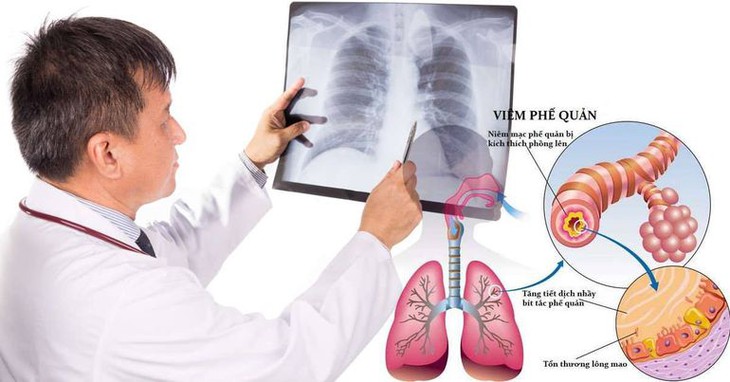 Bệnh viêm tiểu phế quản ở trẻ: Nhận biết, điều trị và những lưu ý - Ảnh 2.