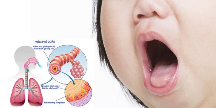 Bệnh viêm tiểu phế quản ở trẻ: Nhận biết, điều trị và những lưu ý - Ảnh 6.