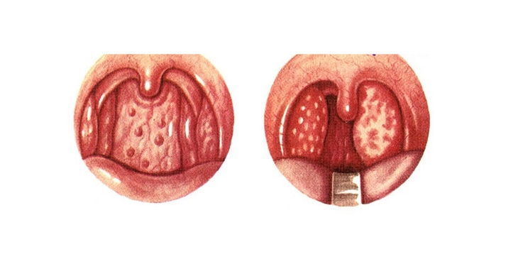 Viêm họng hạt: Nguyên nhân, triệu chứng chẩn đoán, điều trị và phòng ngừa - Ảnh 2. Viêm họng hạt: Nguyên nhân, triệu chứng chẩn đoán, điều trị và phòng ngừa - Ảnh 2.