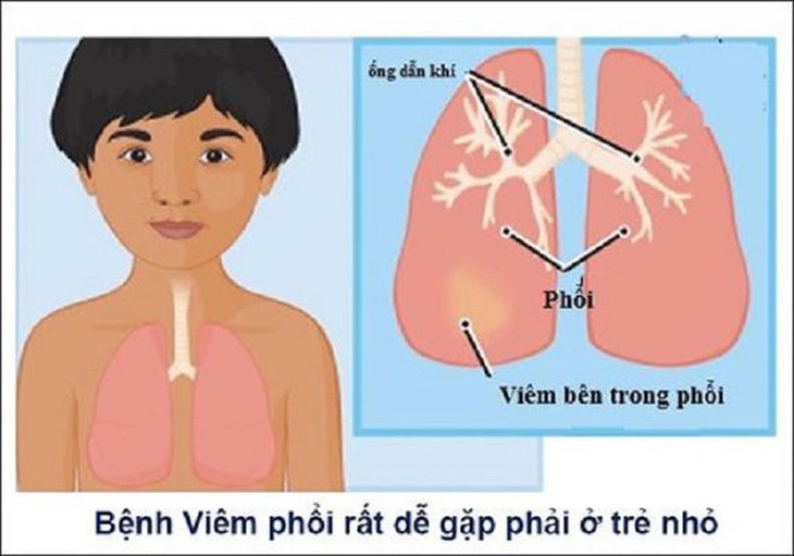 Những lưu ý để phòng bệnh viêm phổi cho trẻ trong mùa lạnh - Ảnh 3.