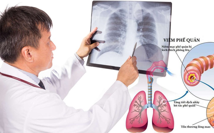 Bệnh viêm phế quản mùa lạnh: Ai dễ mắc, phòng và điều trị thế nào?
