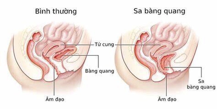 Sa nội tạng vùng chậu có nguy hiểm không? - Ảnh 3.